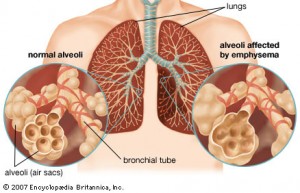 Obat Alami Radang Paru-paru